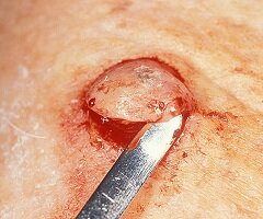 Кератоакантома кожи - причина плоскоклеточного рака
