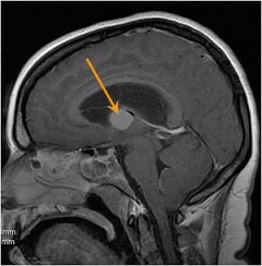 Коллоидная киста головного мозга на снимке МРТ