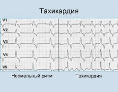 Тахикардия - увеличение частоты сердечных сокращений