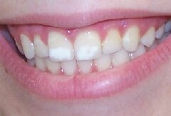 Причины появления белых пятен на зубах