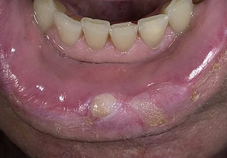 Симптомы рака губы