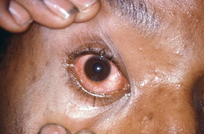 Тяжелые инфекции глаз при осложнениях гонореи
