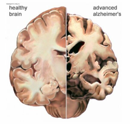 Симптомы болезни Альцгеймера