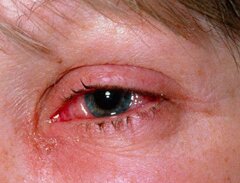 Симптомы ожога глаз