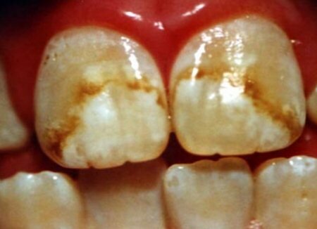 Симптомы флюороза зубов