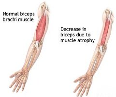 Атрофия мышц - один из симптомов бокового амиотрофического склероза