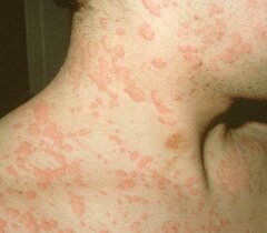 Анафилаксия - острая реакция организма человека на определенный аллерген