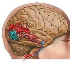 Гипертензия и головные боли - симптомы ангиомы головного мозга