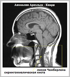 Аномалия Арнольда-Киари - аномальное развитие головного мозга