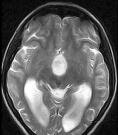 Арахноидальная киста головного мозга на снимке МРТ