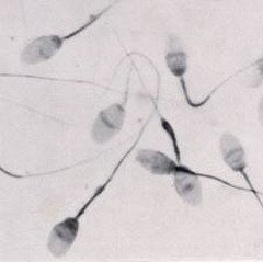 Для выявления астенозооспермии спермограмма может быть проведена в плановом порядке 