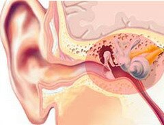 Болезнь Меньера – расстройство внутреннего уха