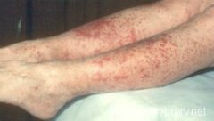 Первыми симптомами геморрагического васкулита являются поражения кожи (покраснения, высыпания)
