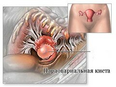 Параовариальной кистой называется полое новообразование, образующееся из ткани придатка яичника