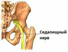 В области перелома седалищной кости может отмечаться повреждение сосудов, мышц, нервов и сухожилий