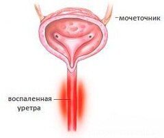 Уретрит - воспаление мочеиспускательного канала (уретры)